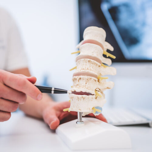Ärztliche Fachkraft zeigt an einem Wirbelsäulenmodell eine betroffene Stelle der Lendenwirbelsäule