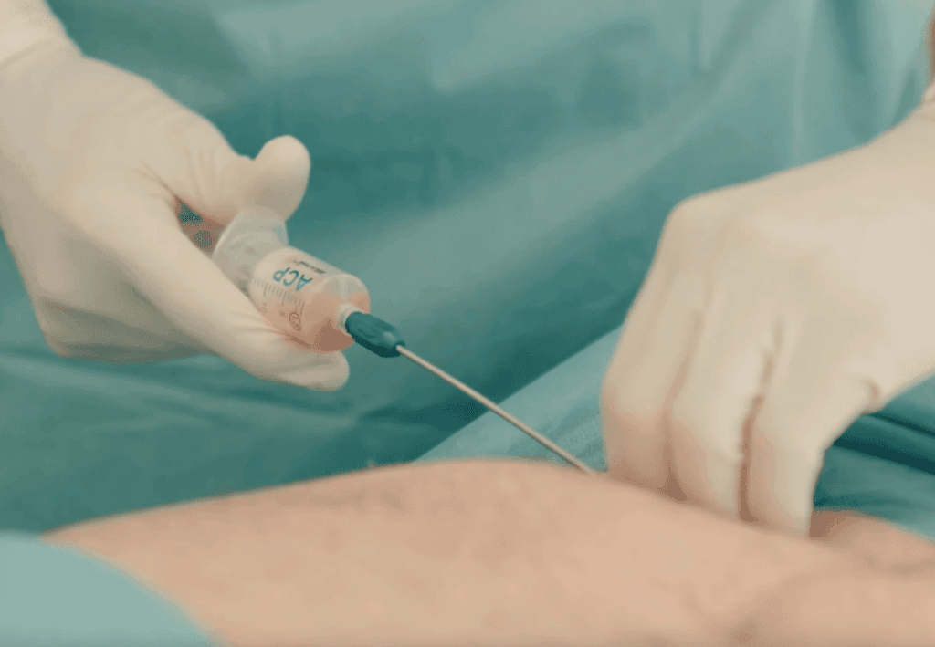 Es werden etwa 30ml Fett entnommen