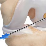 Abbildung eines Autocart Arthrex Knorpelchips