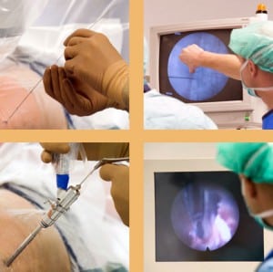 Collage aus vier Bildern einer Bandscheiben OP mit Instrumentenführung und endoskopischer Bildkontrolle