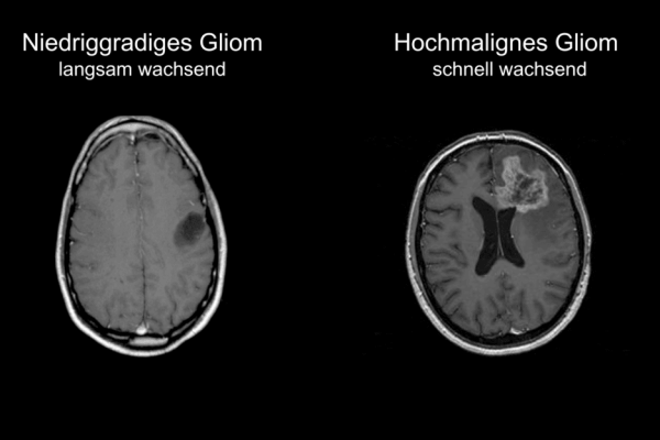 Zwei Aufnahmen - links ein niedriggradiges Gliom, rechts ein hochmalignes Gliom